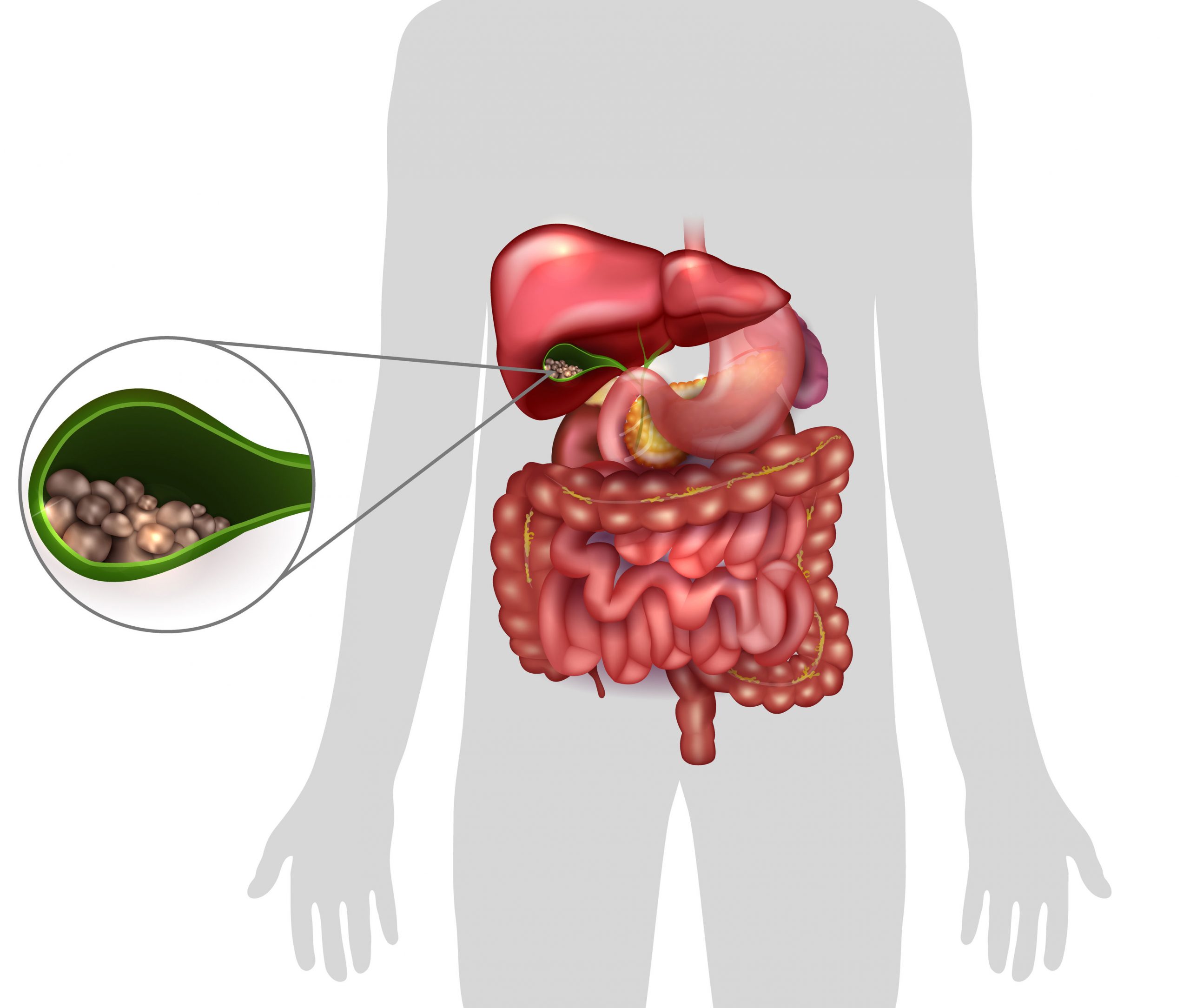 67402631 - gallstones in the gallbladder, human silhouette and anatomy of surrounding organs.