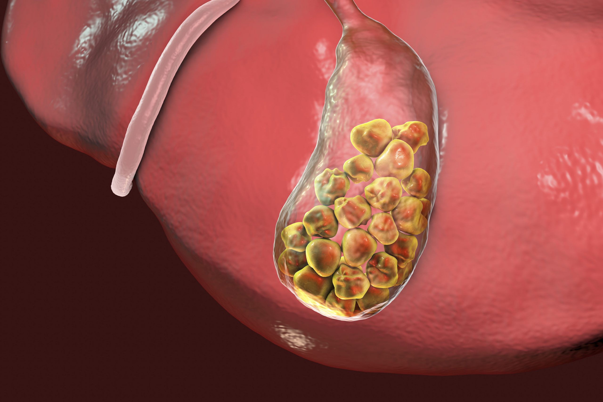 80600184 - gallstones, 3d illustration showing bottom view of liver and gallbladder with stones